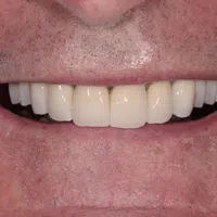Close-up of a man's mouth showing dental veneers or crowns on upper front teeth.