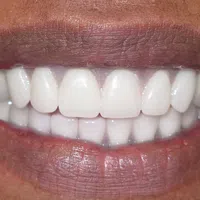 Close-up of a smiling mouth with white, healthy teeth and natural lips in soft lighting.