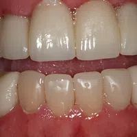 Close-up of natural upper and lower teeth with healthy pink gums and slight tooth color variation.