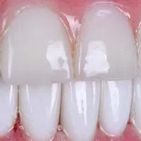 Close-up of clean, white upper and lower front teeth with healthy pink gums and shiny enamel.