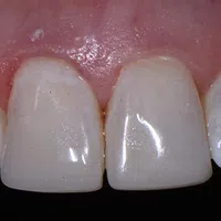 Close-up of upper front teeth and gums showing natural tooth texture and coloration.