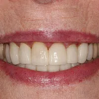 Close-up of a smiling mouth showing clean, white teeth with lips and skin texture visible