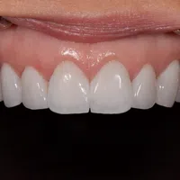 Close-up of well-aligned, clean, and bright upper front teeth with healthy gums and dental retractors.