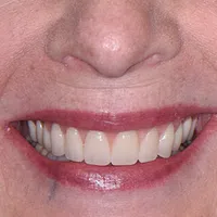 Close-up of a smiling person's mouth showing straight, white teeth and natural lip color.
