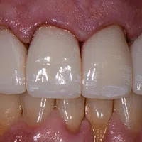 Close-up of upper and lower teeth showing dental crowns and natural teeth with gum tissue visible.