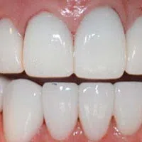 Close-up of a healthy smile showing clean, white teeth with no visible staining or damage on gums.