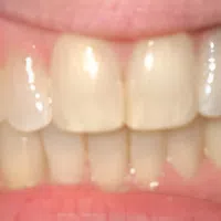 Close-up of natural teeth showing slight discoloration and healthy gums in a neutral smile.