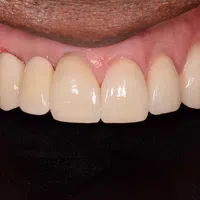 Close-up of a healthy smile showing natural upper front teeth and pink gums against a black background