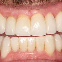Close-up of a smiling mouth showing well-aligned clean upper and lower teeth with natural gums visible.