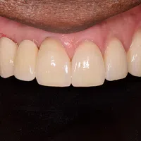 Close-up of a person's upper front teeth with natural gums against a black background.