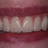 Close-up of a smiling mouth showing clean, straight, white teeth and healthy pink gums.