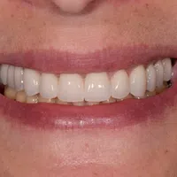 Close-up of a smiling mouth showing clean, white, evenly aligned teeth and healthy lips.