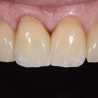 Close-up of healthy upper front teeth and pink gums against a black background.