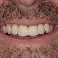 Close-up of a smiling man's mouth showing natural teeth and a mustache with gray and brown hair