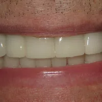 Close-up of a smiling mouth showing teeth and lips with natural skin texture and light facial hair.