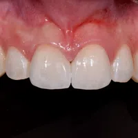 Close-up of upper front teeth and gums showing healthy enamel and pink gum tissue against black background.