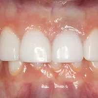 Close-up of healthy white teeth and gums showing dental alignment and natural shine under bright light.