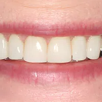 Close-up of a smiling mouth showing clean, white teeth and healthy pink lips.