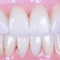 Close-up of clean, healthy teeth with natural gums and bright white enamel, showing full smile alignment.