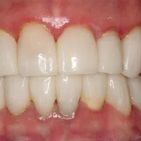 Close-up of a full set of upper and lower human teeth with healthy gums and natural color.