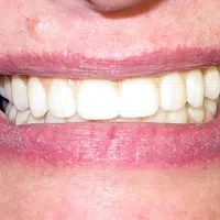 Close-up of a smiling mouth showing clean, white teeth and natural pink lips.