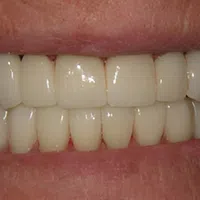 Close-up of a smiling mouth showing clean, white, evenly aligned teeth with healthy gums.
