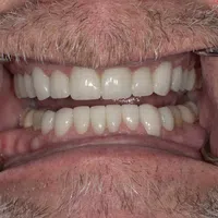 Close-up of an elderly man's mouth with dental retractors showing upper and lower teeth and gums