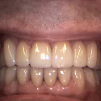 Close-up of a dental patient's mouth showing clean, healthy upper and lower teeth with dental tools on sides.