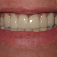 Close-up of a smiling mouth showing clean, straight, and white teeth with healthy gums.