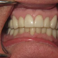Close-up of a person's mouth showing clean, well-aligned upper and lower teeth with dental retractors.