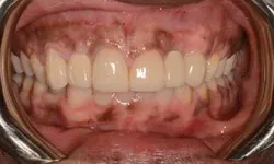 Thumbnail control image for Close-up of a dental prosthesis fitted in lower gums with visible metal dental tool edges.