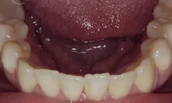 Thumbnail control image for Close-up of lower teeth and tongue inside an open mouth showing natural dental alignment and gums.