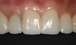 Thumbnail control image for Close-up of healthy, clean upper front teeth with pink gums and reflective enamel.