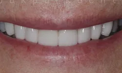 Thumbnail control image for Close-up of a bright white smile showing healthy, evenly aligned teeth and natural lips.
