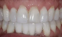 Thumbnail control image for Close-up of clean, white, well-aligned upper and lower human teeth and gums.