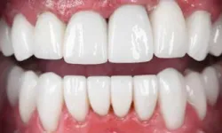 Thumbnail control image for Close-up of bright white and perfectly aligned upper and lower teeth with healthy pink gums.
