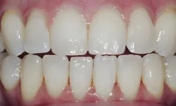Thumbnail control image for Close-up of healthy upper and lower natural teeth with pink gums and no visible dental issues.