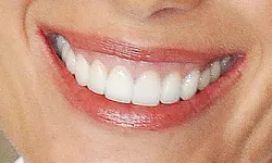Thumbnail control image for Close-up of a smiling mouth with white teeth and glossy lips.