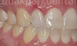 Thumbnail control image for Close-up of human teeth showing natural color variation and gum health in a detailed dental image.
