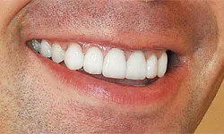 Thumbnail control image for Close-up of a smiling person showing clean, white teeth and part of their lips and skin texture.