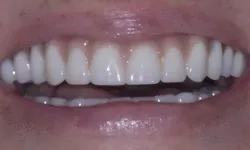 Thumbnail control image for Close-up of healthy, clean, white teeth with natural gums and lips visible in a smile