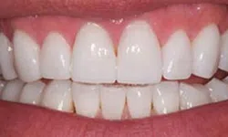 Thumbnail control image for Close-up of a bright, healthy smile showing clean white teeth and pink gums.