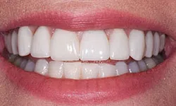 Thumbnail control image for Close-up of a healthy smile showing clean, white teeth and lips with natural texture.