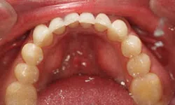Thumbnail control image for Close-up of lower dental arch showing clean, white teeth and healthy gums inside the mouth