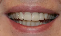 Thumbnail control image for Close-up of a smiling mouth showing clean, white teeth and natural lips.