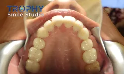 Thumbnail control image for a person holding a baby's mouth with white pills in it