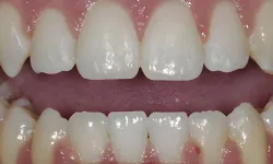 Thumbnail control image for Close-up of human teeth showing a diastema gap between upper front teeth and healthy gums.