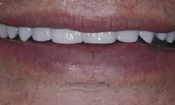 Thumbnail control image for Close-up of a smile showing clean, white upper teeth and natural lips with some facial hair.