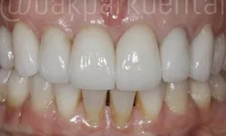 Thumbnail control image for Close-up of teeth showing dental veneers on upper front teeth with natural lower teeth and gums visible.