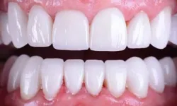 Thumbnail control image for Close-up of healthy white upper and lower teeth with pink gums and no visible dental issues